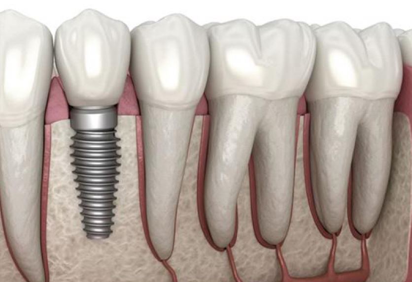 ایمپلنت دندان برای چه سنی است؟