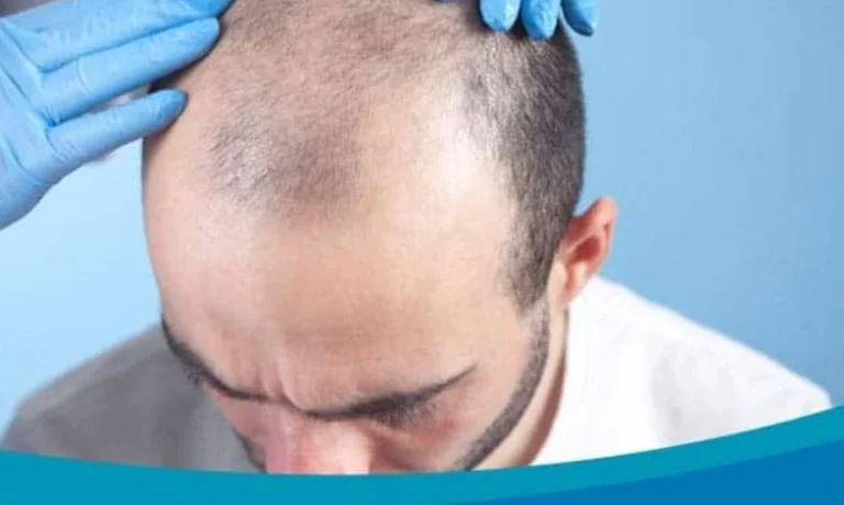 بهترین زمان برای کاشت مو چه سنی است؟