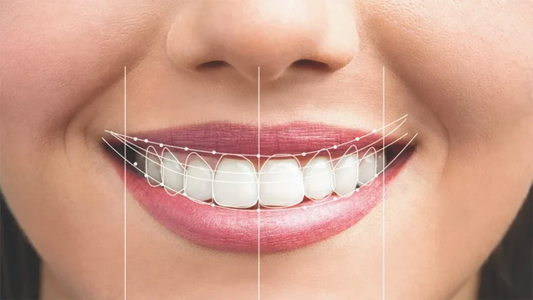 نحوه تراش دندان برای لمینت