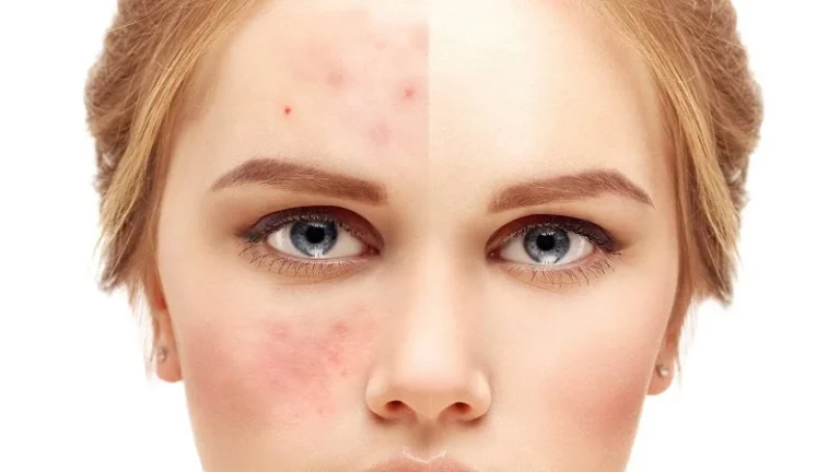 فیشیال برای جوش زیر پوستی