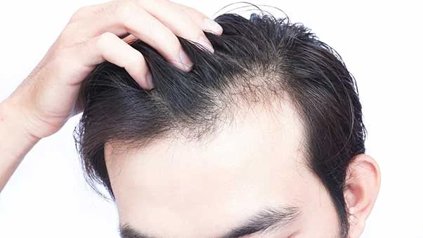 Signs and symptoms of hereditary hair loss and ways to prevent it