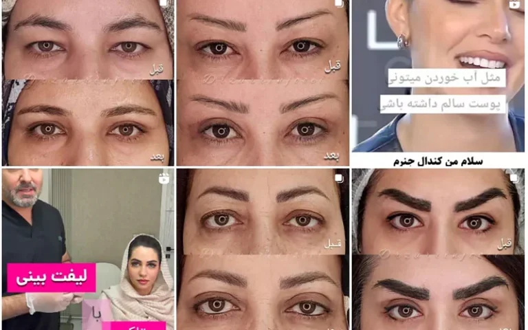 بهترین سن برای عمل بلفاروپلاستی چه سنی است؟