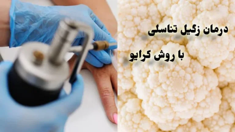 فریز زگیل تناسلی چگونه است؟