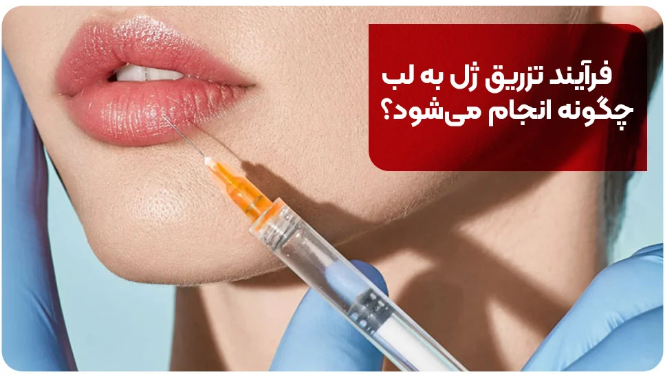 فرآیند تزریق ژل به لب چگونه انجام میشود؟